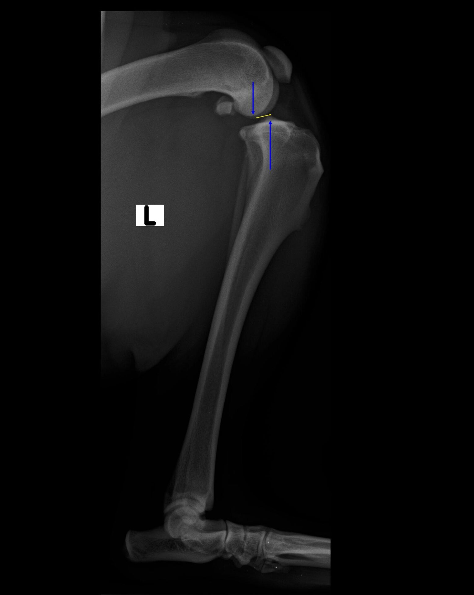 Rx post-operatoria che mostra l’osteotomia eseguita e l’applicazione della placca per la stabilizzazione dell’osteotomia dopo rotazione.