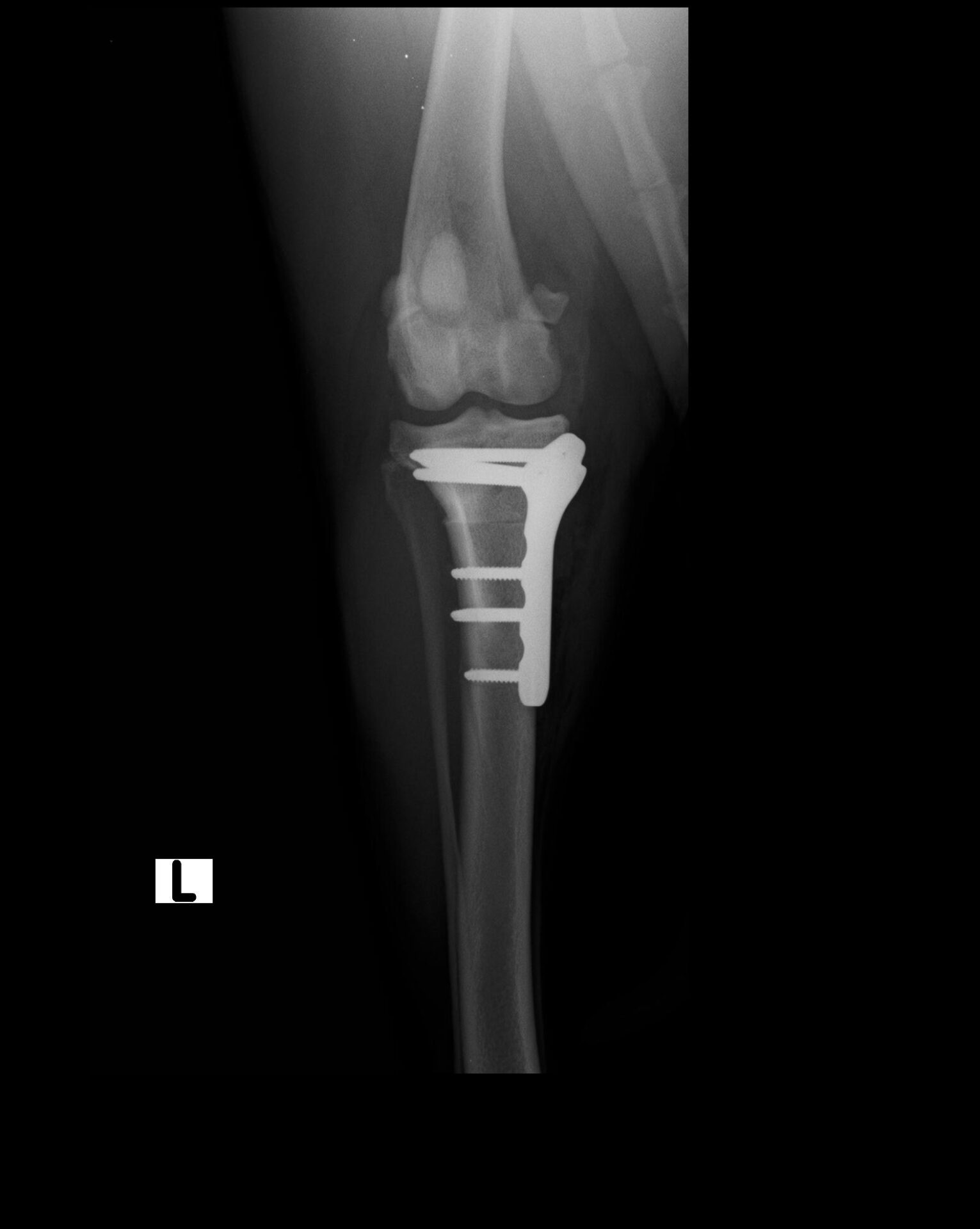 Rx post-operatoria che mostra l’osteotomia eseguita e l’applicazione della placca per la stabilizzazione dell’osteotomia dopo rotazione.
