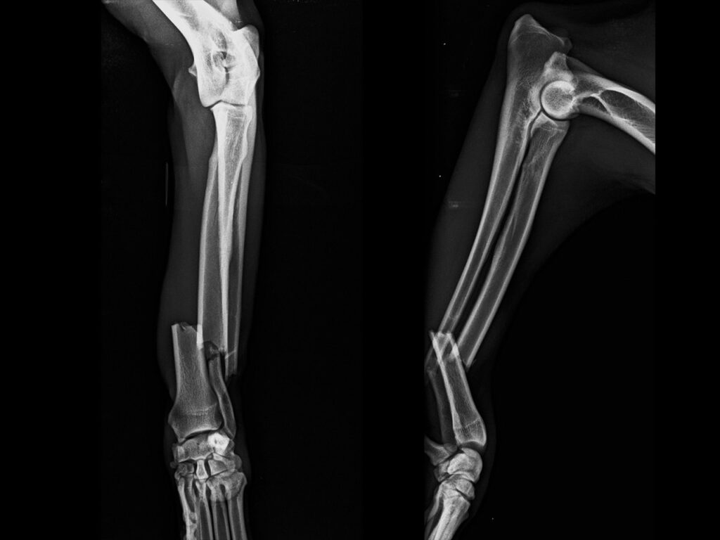 Frattura diafisaria trasversa del radio e dell'ulna sinistro