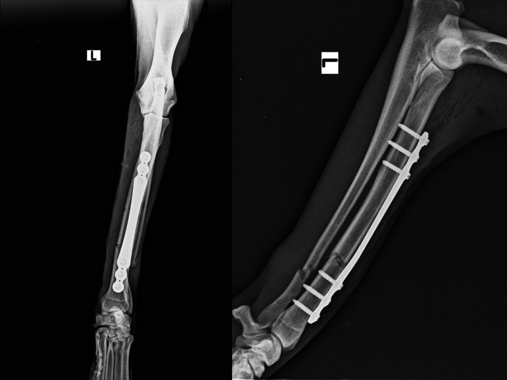 frattura diafisaria trasversa del radio e dell'ulna sinistro